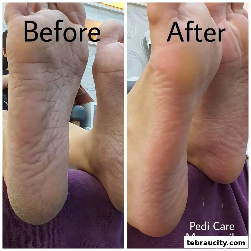 A split image showing a 'before' and 'after' comparison of a foot's sole after pedi care.